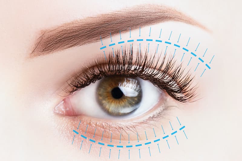 Baggy Eyelids Surgery (Blepharoplasty)