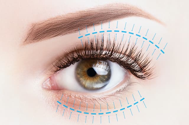 Baggy Eyelids Surgery (Blepharoplasty)