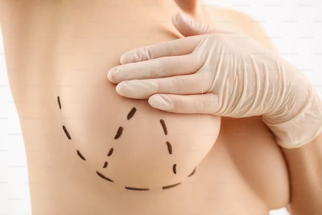 Breast Lift with Enhancement