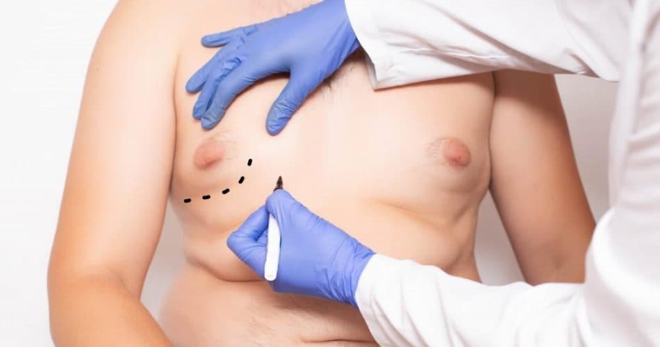 Male Breasts (Gynecomastia)